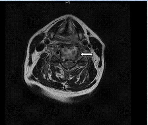 Axial T2 FSE cervical image. There is enhancement of the C4 and C5 vertebral bodies consistent with osteomyelitis