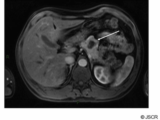 Arterial phase gadolinium enhanced MRI demonstrating primary tumour (arrow)