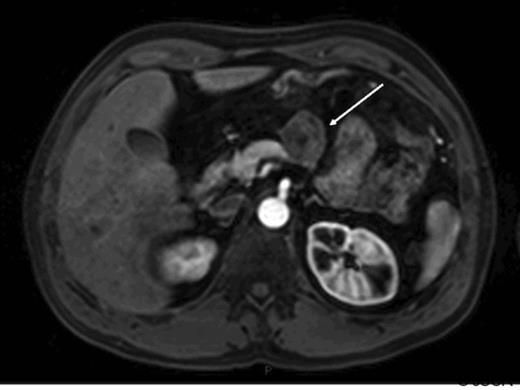 Arterial phase gadolinium enhanced MRI demonstrating lesion reported as being consistent with recurrent neuroendocrine cancer (arrow).