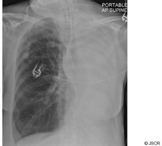Chest radiograph on admission to Intensive Care Unit