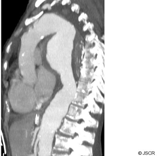 Sagittal CT section showing large thoracic aneurysm