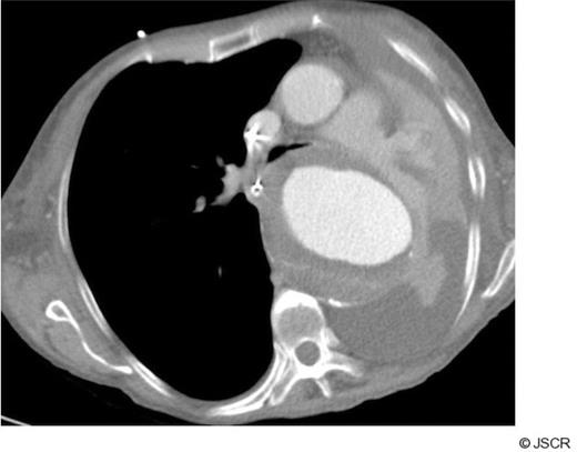 CT chest showing complete compression of left main bronchus by large aortic aneurysm