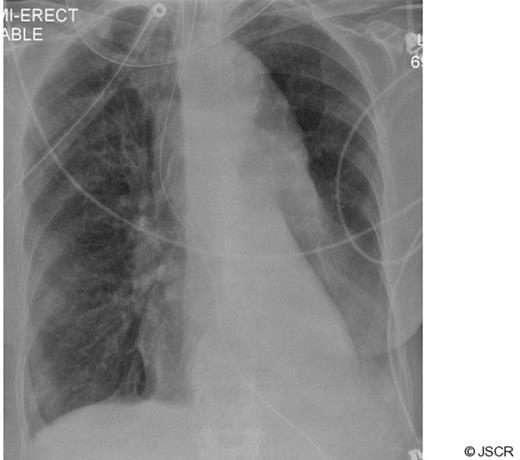 Chest radiograph post stenting to left main bronchus
