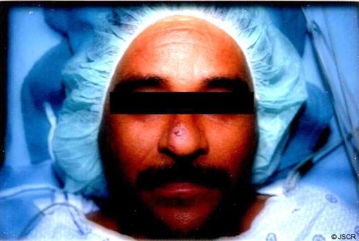 Presenting lesion following initial biopsy at outside facility.