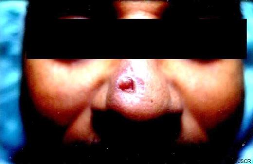 Expanded view detailing location of two distinct lesions on the nasal tip.