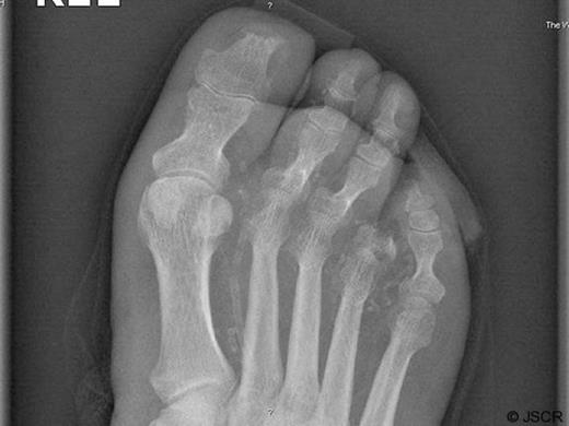Postoperative x-ray of the right foot demonstrating the amputated fourth toe. The Xray also demonstrates the phalanxes of the fifth toe being used to construct the flap used to close the defect.
