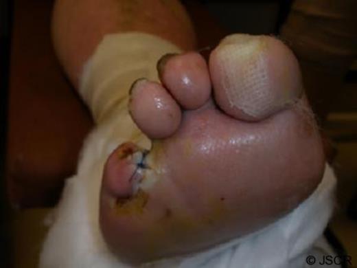 Close-up appearance of the flap seven days postoperatively.