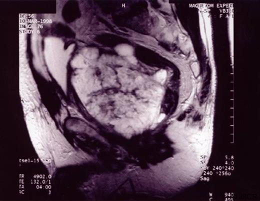MRI scan showing an enormous multicystic tumour arising from the prostate gland infiltrating the posterior wall of the bladder and also involving the rectum