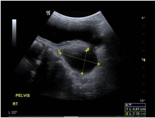 Ultrasound images demonstrating a large bladder diverticulum