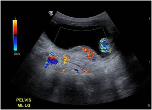 Ultrasound images demonstrating a posterior bladder wall lesion with increased vascularity