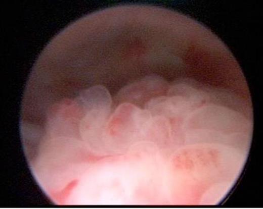 Papillary lesion seen on posterior bladder wall at cystoscopy