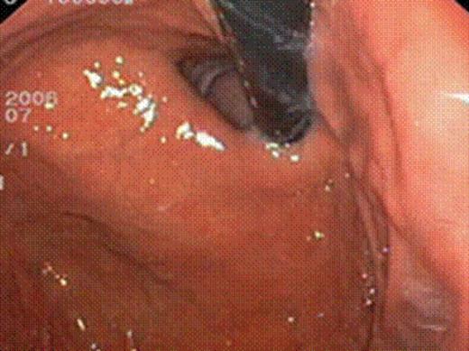 pre-operative EGD showing Hill grade I gastro-esophageal valve