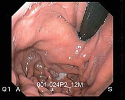 Post operative view of the esophageal valve.