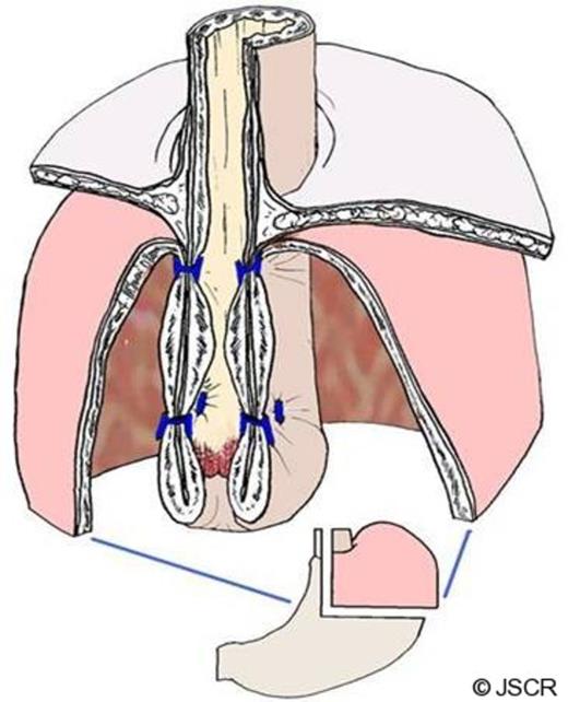 Full thickness serosa-serosa plication at 1-2 cm and 3-4 above the gastro-esophageal junction.