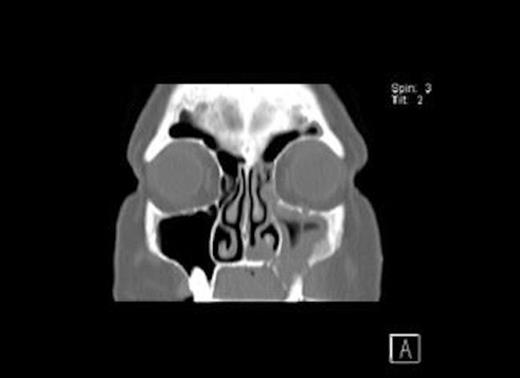 Coronal CT Scan of the head showing osseo-sclerotic changes / oroantral fistula floor of left maxillary sinus