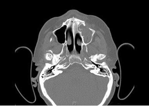 Axial CT Scan of the head showing osseo-sclerotic changes and defect in left maxillary sinus