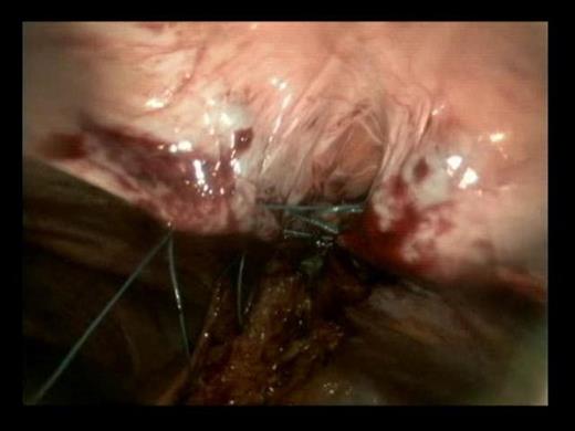 Insertion of horizontal mattress sutures