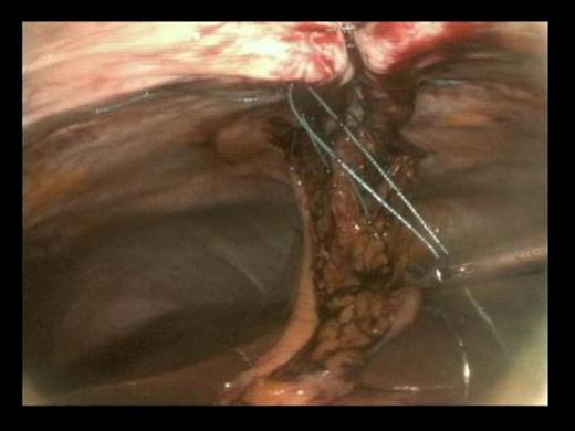 Sutures along length of diastasis