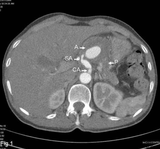 Contrast CT shows partially thrombosed splenic artery aneurysm. ( A =aneurysm, SA =splenic artery, CA =celiac artery, P =pancreas)