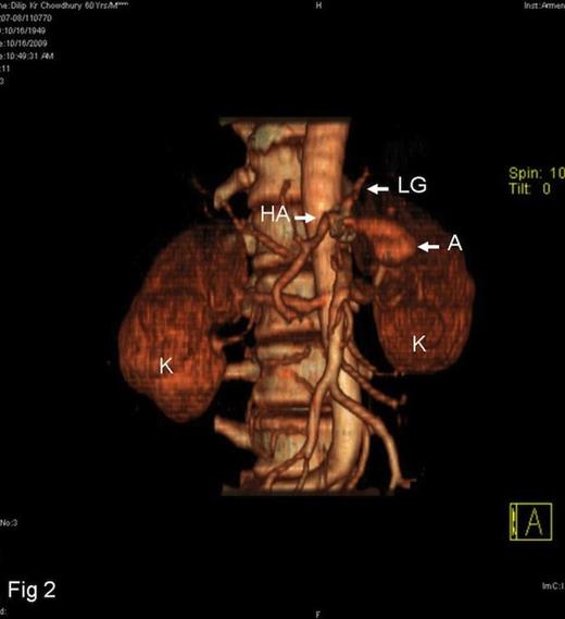 3D-CT reconstruction of the aneurysm ( HA =hepatic artery, LG =left gastric artery, A =aneurysm, K =kidney)