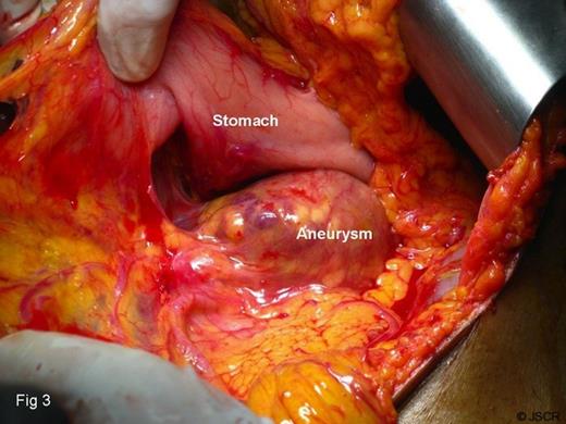 Intra-operative photograph of aneurysm
