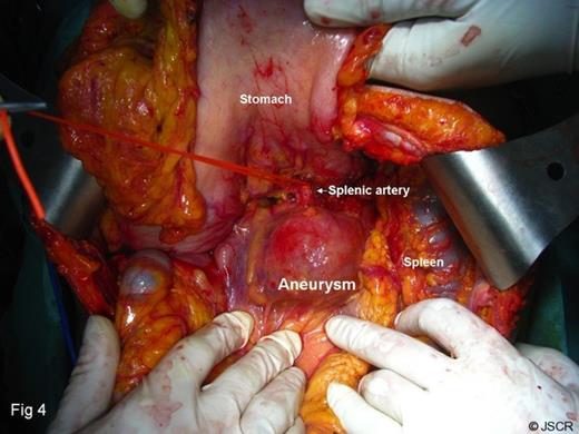Vascular loop around the splenic artery proximal to aneurysm