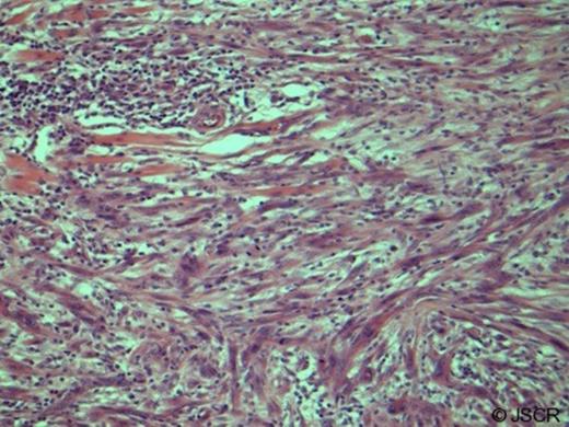 Malignant peripheral nerve sheath tumour showing pleomorphic, mitotically active spindle cells infiltrating the dermis and muscles of facial expression (haematoxylin and eosin, original magnification x20 low power). Immunohistochemistry showed that the lesion was an Actin+ S-100+ neoplasm providing diagnosis of MPNST.