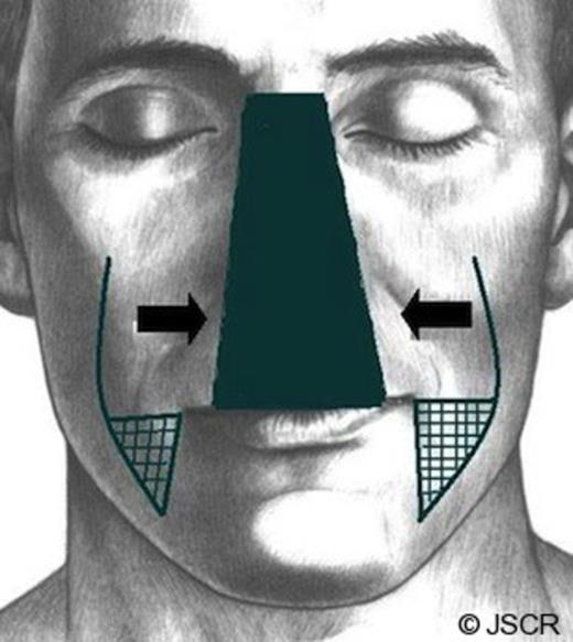 An illustration of a modified Karapandzic flap. The flap is raised around the nasal defect rather than the oral fissure to reconstruct the upper lip. The vermillion is reconstructed using mucosal advancement flaps from moth limbs of the reconstruction.