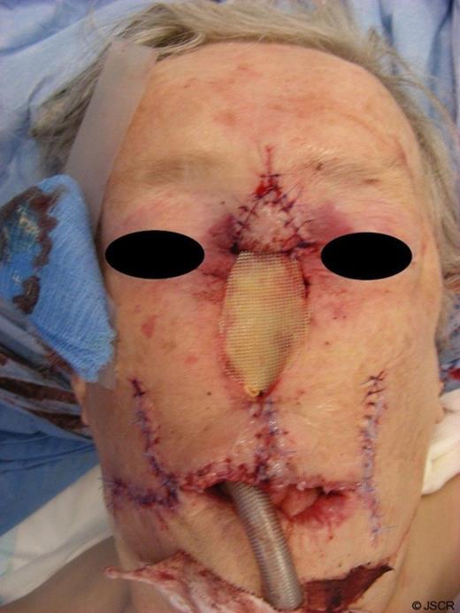 Final outcome of reconstruction at end of procedure.