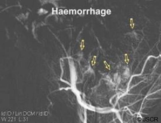 Angiograms pre-embolisation with Histo-acryl