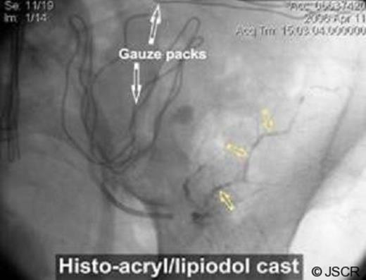 Angiograms post-embolisation with Histo-acryl
