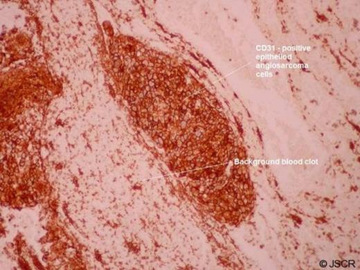 (CD31 immunohistochemistry: Immunoperoxidase, original magnification x100)