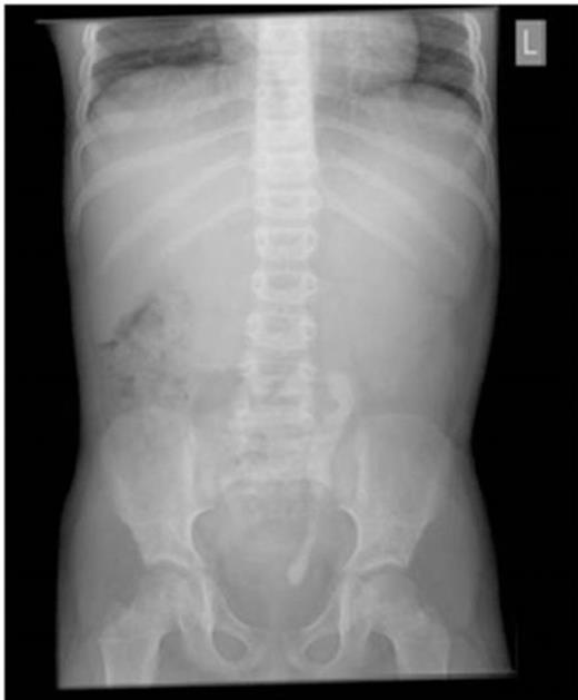 Plain abdominal radiograph demonstrating large opacity extending from the left pelvi-ureteric junction to the mid ureter, and a smaller opacity in the distal ureter.