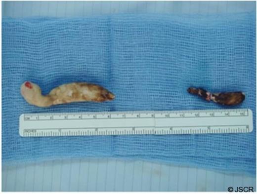 Ureteric calculi removed from the proximal (left ) and distal (right) ureter.