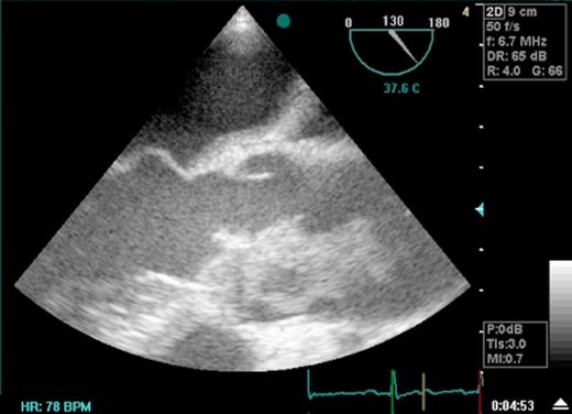 Transoesophageal Echocardiogram depicting thrombus in the ascending aorta
