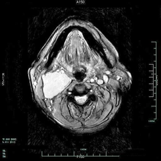 CT angiography of a 4 x 4 x 8.5cm right glomus vagale. Mass is located posterior to the carotid sheath with anterior displacement of carotid bifurcation and the internal carotid artery.