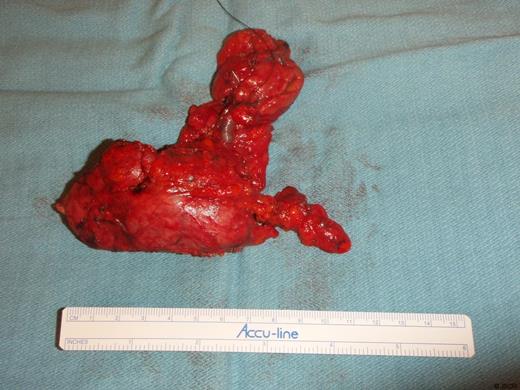 Dissected R. glomus vagale tumour.