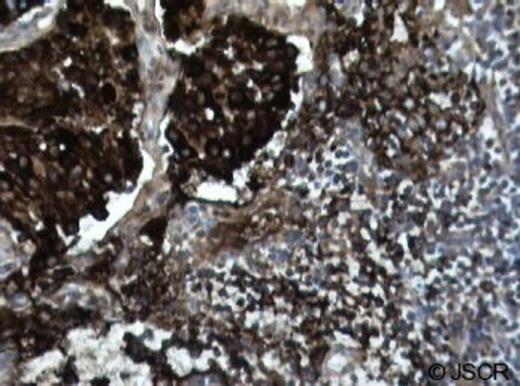 Chromogranin-stain of the dissected lymph node. Lymph node stained positive for chromogranin, confirming the presence of metastatic disease (dark brown/black cells).