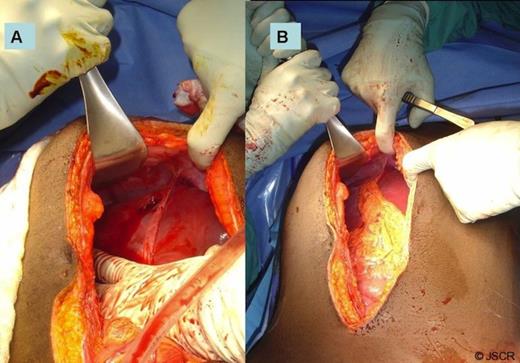 Liver injury with cavitary defect (A). Repair with Omental packing (B).