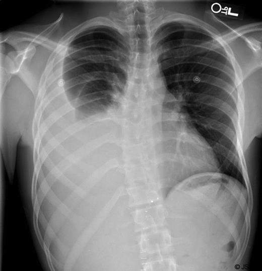 eturn CXR with large right effusion.