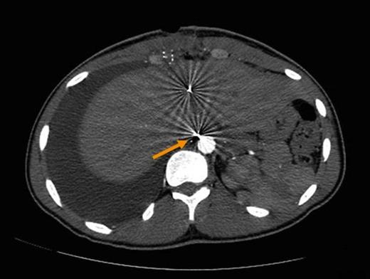 Computerized tomography of the abdomen demonstrating tiny metallic fragments within liver. Fragment adjacent to aorta suspected of injuring retroperitoneal thoracic duct (arrow).