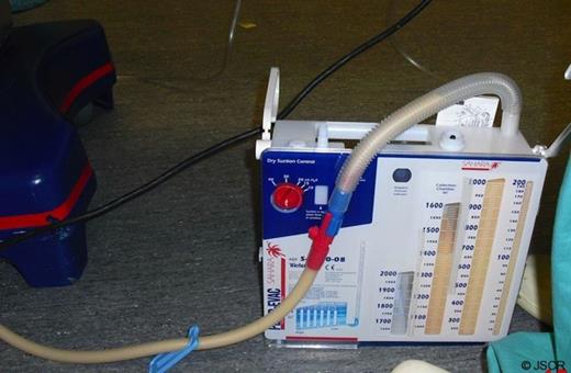 Chest tube with classic appearance of milky white chyle.