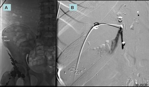 Lymphangiogram mapping through groin (A) with attempted embolization of thoracic duct utilizing fluoroscopy (B).