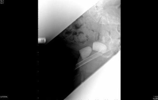 Plain Radiographs demonstrating two bladder calculi