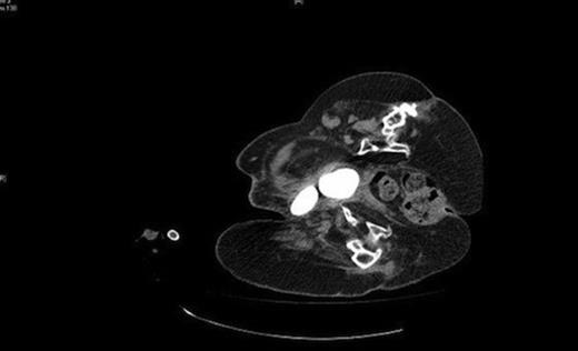 CT demonstrating the two bladder calculi pointing towards the right groin