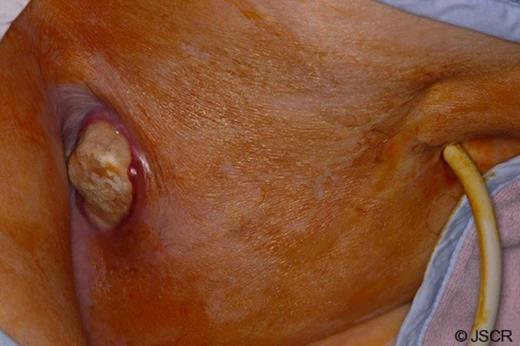 Intraoperative view of the bladder calculi emerging through the vesicocutaneous fistula into the right groin