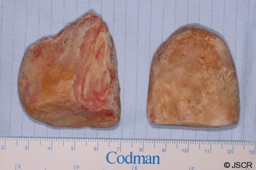 The two bladder calculi following extraction