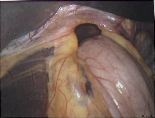 Hiatus hernia with portion of stomach seen going into the chest