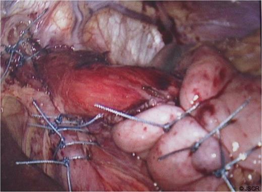 Crural repair with fundoplication