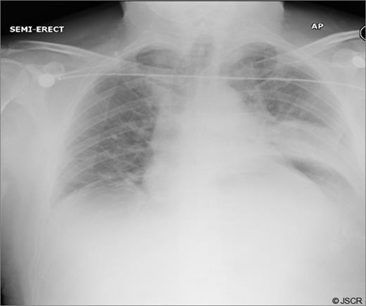 Early post-op chest x-ray showing patchy shadowing/ consolidation over the left side of chest